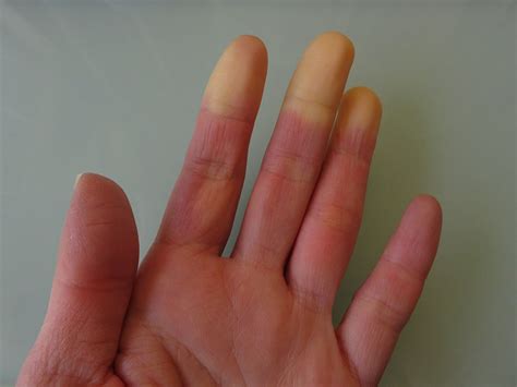 maladie de raynaud main